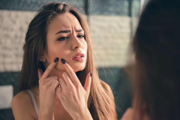 ニキビ肌の方は皮脂コントロールやピーリング、消炎成分がおすすめ
