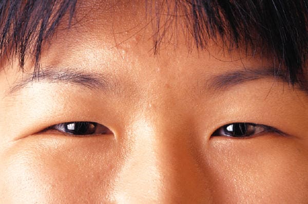 「ものもらい」をどう治す？Vol.3