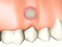 これだけは知っておきたい！ 口内炎