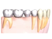 永久歯を抜いてしまった！初めてのブリッジ