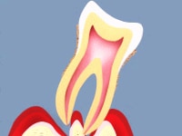 歯周病のウソ?　ホント！