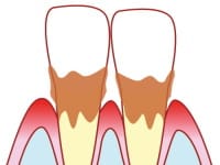 口の時限爆弾？ 「隠れ歯周病」にご用心！