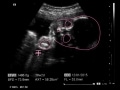 妊娠30週 胎児の体重や大きさをエコー写真で確認・逆子や早産の心配