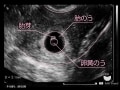 妊娠6週目 エコー写真・胎芽や胎嚢大きさ・心拍確認や気になる流産