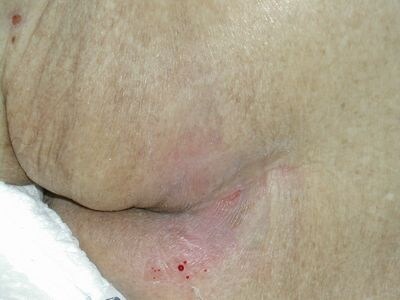 床ずれ(褥瘡・じょくそう）の症状・原因 [皮膚・爪・髪の病気 ...