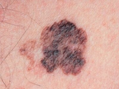 表在性黒色腫を防ぐことは可能ですか?