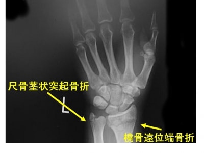 骨折の治療とリハビリテーション: 書籍／南江堂