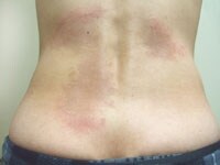 2/2 ステロイド外用剤は家庭の常備薬! 湿疹・皮膚炎 All About