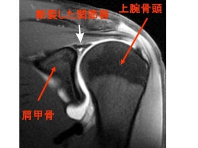 上方肩関節唇損傷の症状・診断・原因・治療 [骨・筋肉・関節の