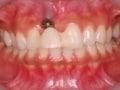 歯科インプラントにおけるトラブル・失敗