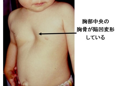 漏斗胸の診断・治療 [骨・筋肉・関節の病気] All About