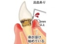 口臭と歯周病の親密な関係