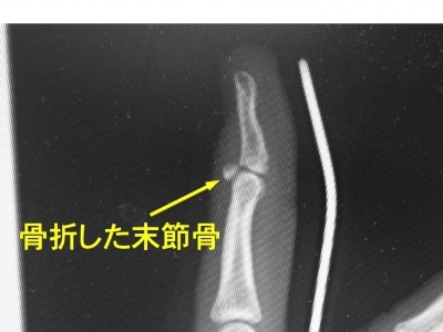 指骨 手掌骨解剖图 手指关节图解 指骨解剖图