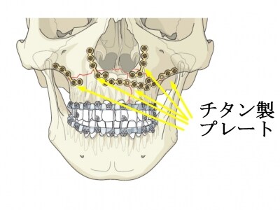 Lefort骨折 Lefort 2 Lefort三型骨折 Lefort截骨术