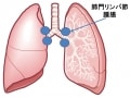 サルコイドーシスの症状・検査・治療