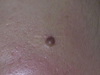 母斑・粉瘤・脂肪腫…皮膚にある「できもの」これ何!? [皮膚 ...