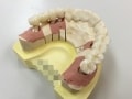 歯科インプラント上部構造の交換について