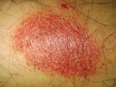 皮膚の病気は人種でどう違う？ 皮膚・爪・髪の病気 All About