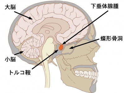 下垂体腺腫の症状・診断・治療 [脳・神経の病気] All About