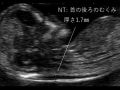 胎児の首の後ろのむくみ（浮腫）「NT」とは？