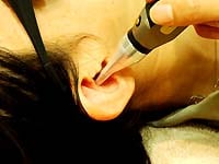レーザー照射