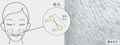 帯状毛穴