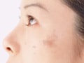 皮膚科美容外来医に聞く！肝斑（かんぱん）